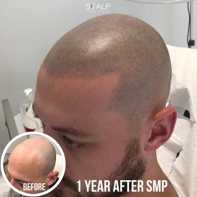 1 year healed hair tattoo for men profile view soft natural hairline checkup