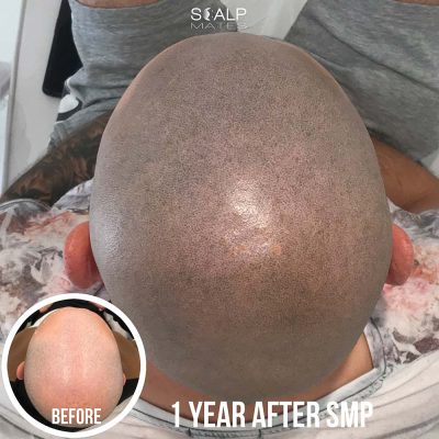 Tattooing for baldness 1 year healed result overhead crown coverage without touchup