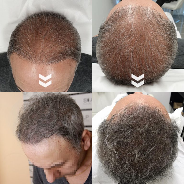 Scalp Micropigmentation in Birmingham UK The BEST Hair Loss Solution