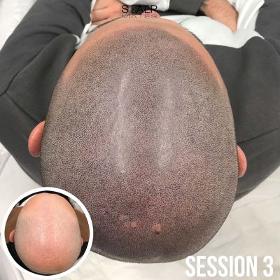 Overhead scalp micropigmentation for men session 3 dark hair tattoo result