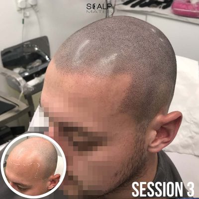 Young Caucasian male hair tattoo for bald head session 3 completion Scalp Mates Birmingham