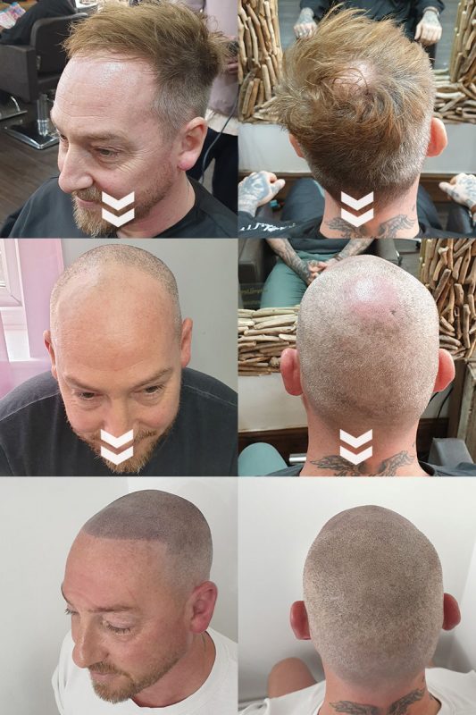 Our Clients ️ it | Before & After Scalp Micropigmentation for Men