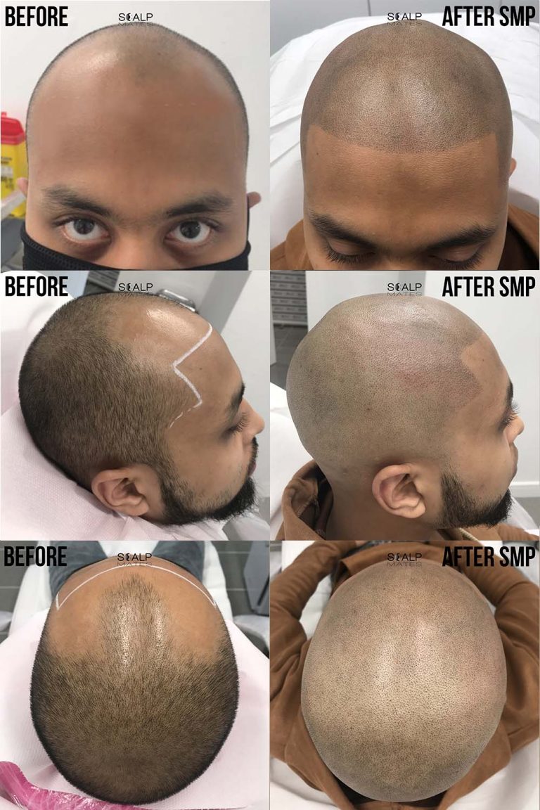 Scalp Micropigmentation (SMP) for Long Hair LIFECHANGING Density Boost