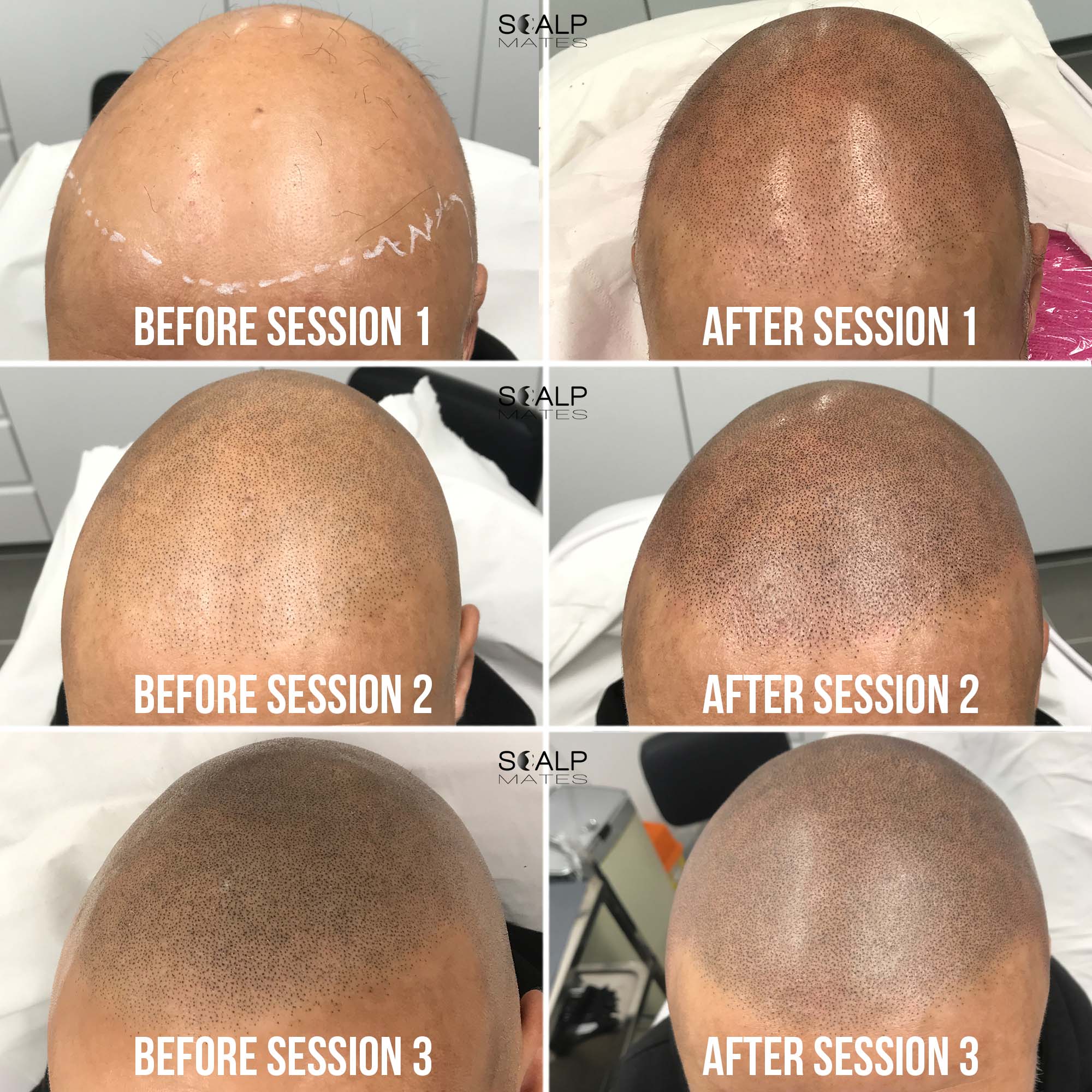 Realistic Hairline Tattoo Scalp Micropigmentation SMP For Short 