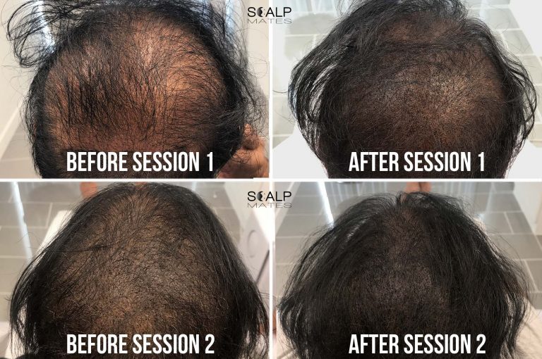 Scalp Micropigmentation SMP for Long Hair in Birmingham UK Results