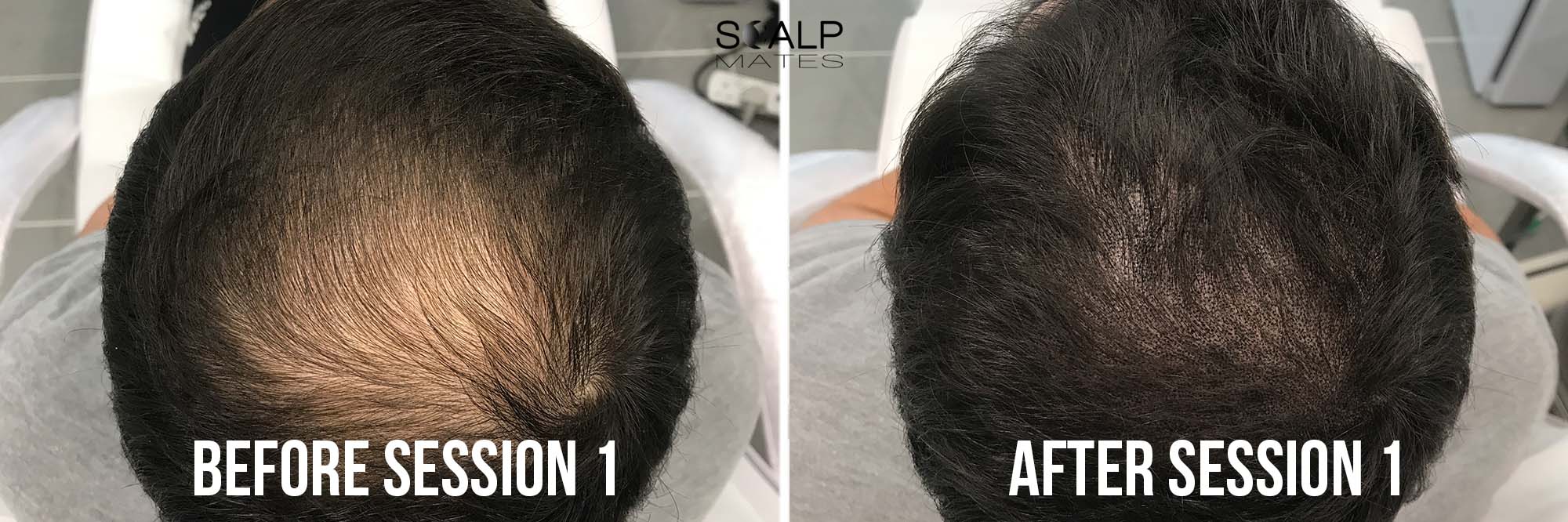 Scalp Micropigmentation SMP for Long Hair in Birmingham UK Results & Process