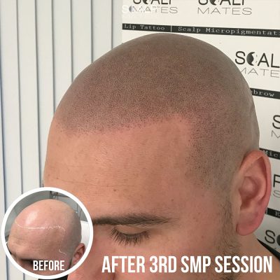 Before and after images of SMP on a shaved scalp showing a natural-looking hairline