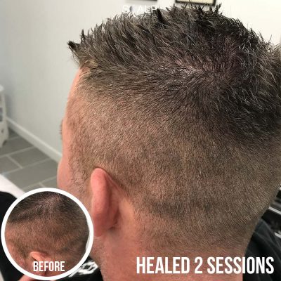 Close up side view of healed 2 session FUE scar hair tattoo camouflage on short cropped donor hair