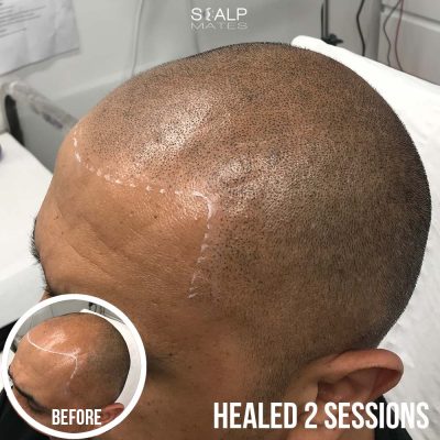 2 sessions healed hair tattoo gfor bald asian male, scalp micropigmentation halal treatment fro balding top, adjusting the hairline lower