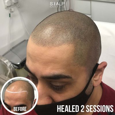 Close up profile view of 2 weeks healed soft natural hairline scalp micropigmentation on Norwood 5 client