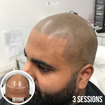 Boxed sharp hairline tattoo for Asian male early 30s 3 sessions completed Scalp Mates Birmingham