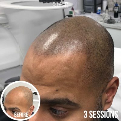 Shaved look scalp micropigmentation 3 session result with 4 days stubble growth showing natural hairline transition