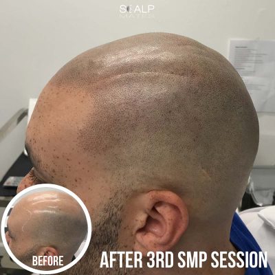 Side profile view showing natural scalp micropigmentation density blending seamless 0.5 shaved hair into real side stubble on a bald male client at ScalpMates Birmingham after 3 sessions.