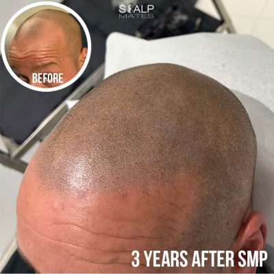 Top down view of healed scalp micropigmentation 3 years post treatment showing natural follicle density