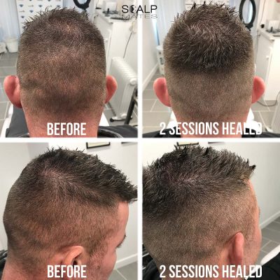 FUE scar hair tattoo camouflage before and healed after 2 sessions on donor area at Scalp Mates Birmingham