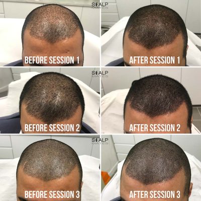 Session progression for scalp micropigmentation thinning hair density boost before and after