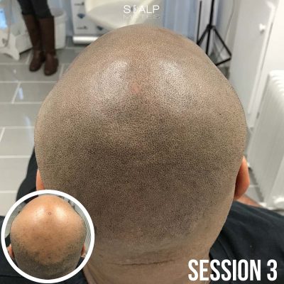 Overhead view 3 sessions healed crown and boxed hairline hair tattoo