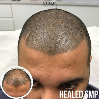 Asian male scalp micropigmentation density boost for diffuse thinning hair healed result Scalp Mates Birmingham