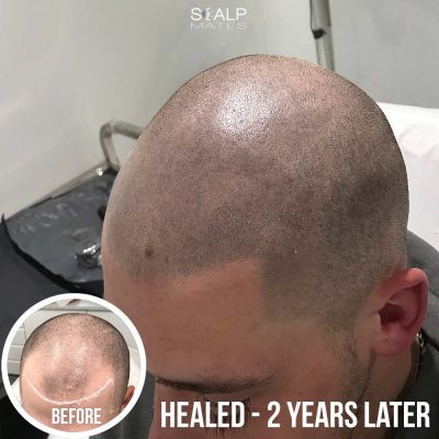 Young male scalp micropigmentation 2 year healed result side profile without touchup Scalp Mates Birmingham
