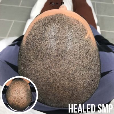 Scalp micropigmentation to add density on crown and top scalp diffuse thinning hair tattoo