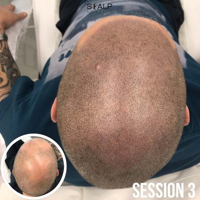 Top crown density scalp micropigmentation result after session 3 for Norwood 5 male pattern baldness