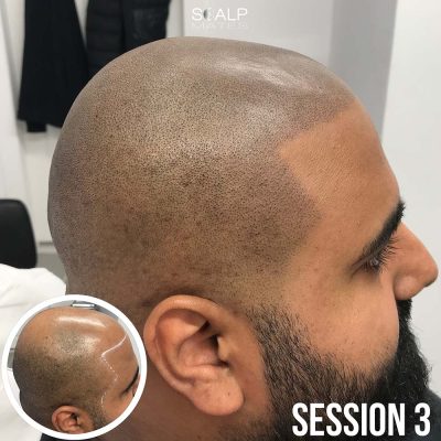 Sharp edge up hairline SMP temple angle on Asian skin tone client from Oxford