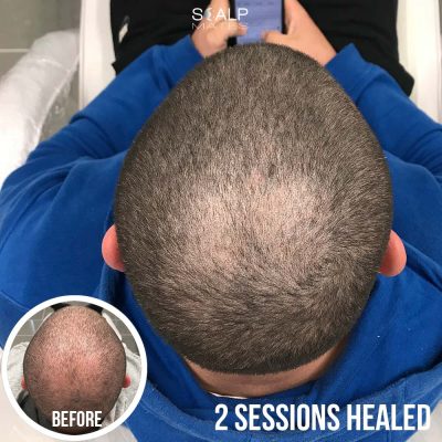 Buzz cut hair tattoo for crown density 2 sessions healed overhead view Scalp Mates Birmingham