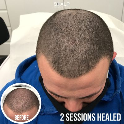 Scalp micropigmentation for thinning crown and frontal hairline on buzz cut male