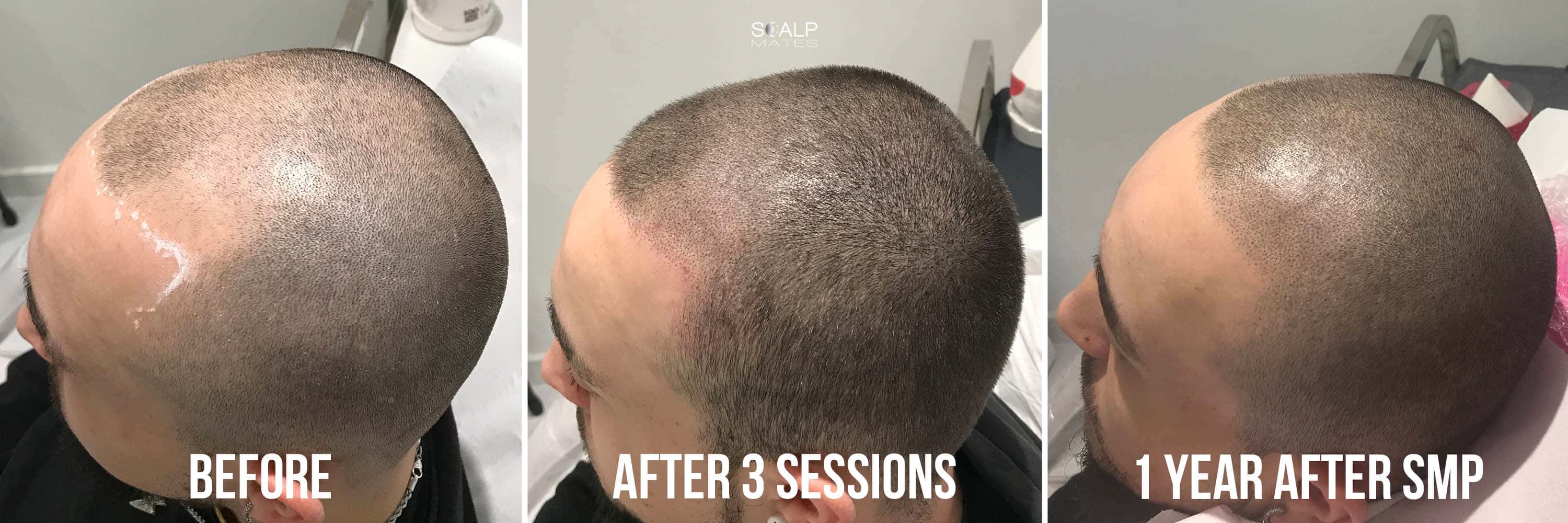 3 panel comparison showing before smp, after 3 sessions with 7 days hair growth, and 1 year healed result close shaved with a foil shaver at Scalp Mates Birmingham