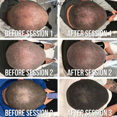 Overhead session progression for crown hair loss scalp micropigmentation density build