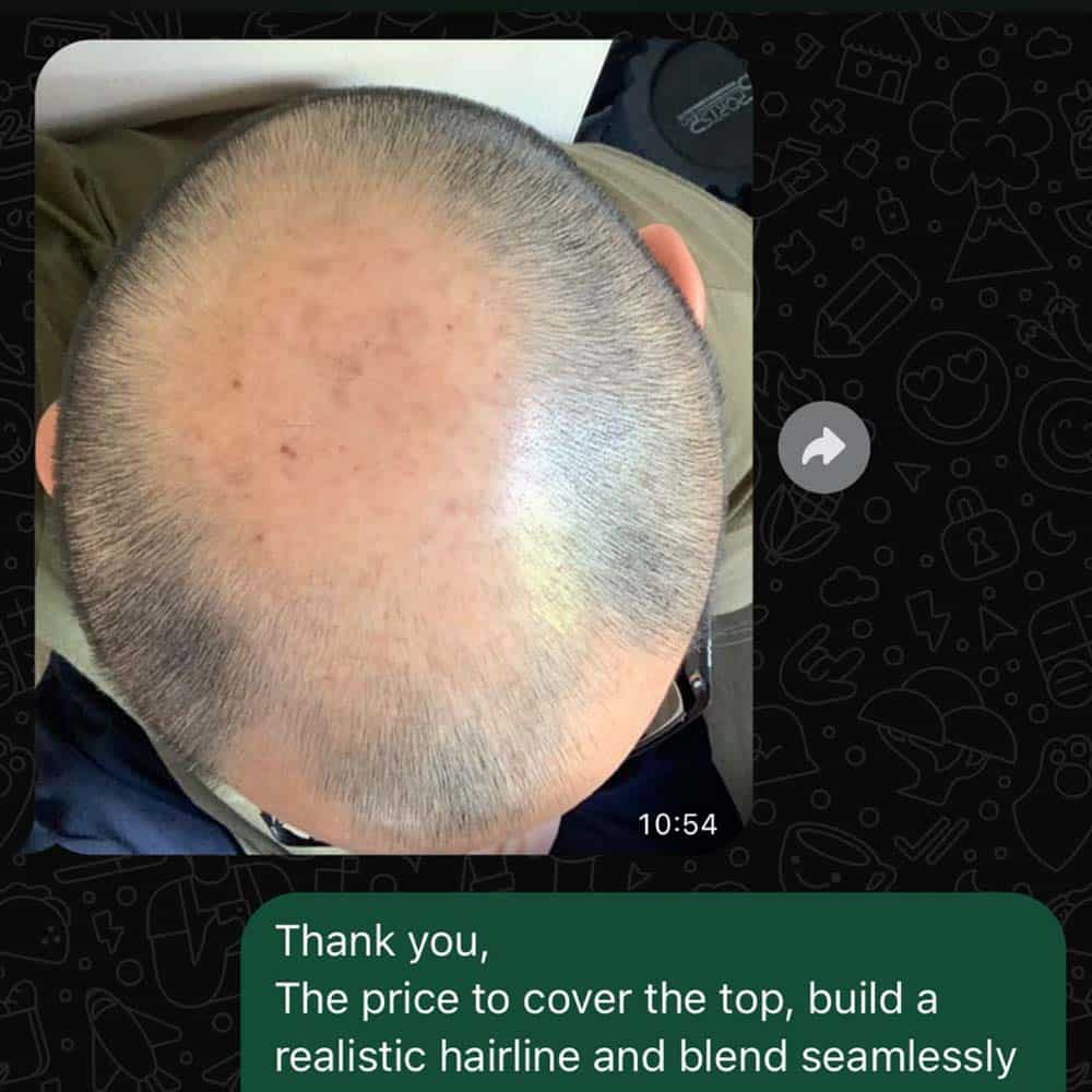 Free virtual scalp micropigmentation photo consultation via WhatsApp for instant hairline restoration quote