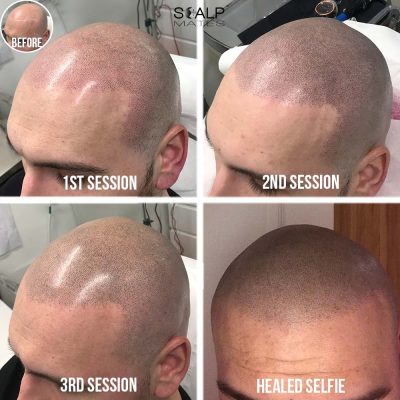 4-panel progression of a hair tattoo for bald man showing session 1, session 2, session 3, and final healed selfie at Scalp Mates Birmingham