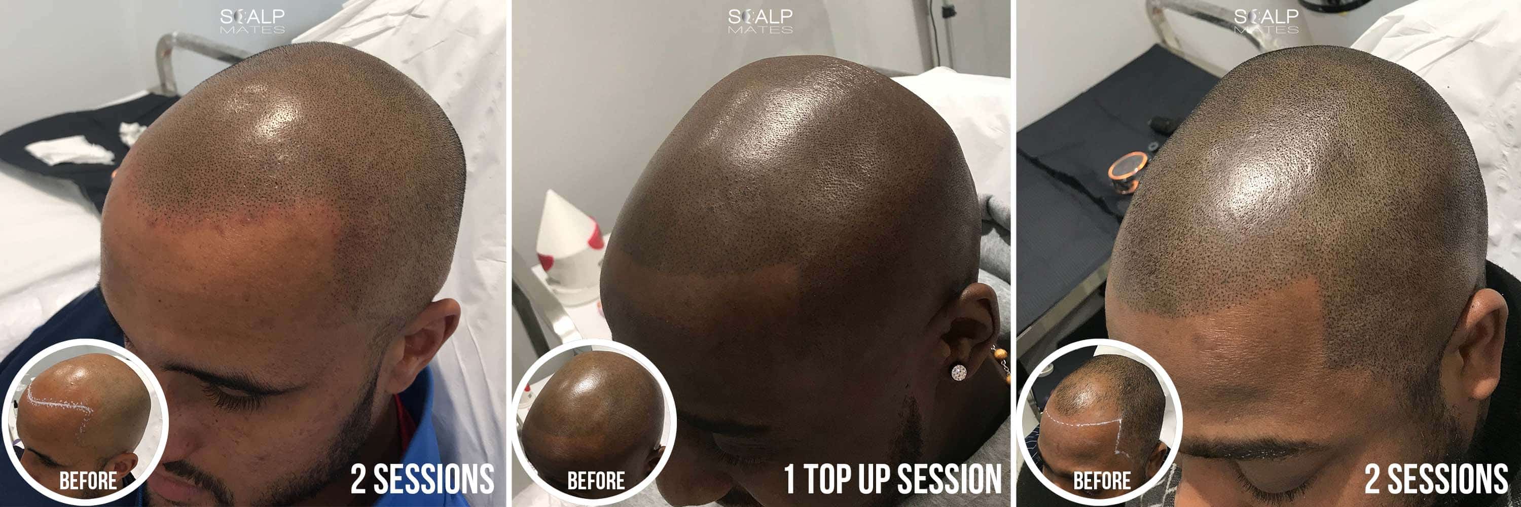 3 panel comparison of a hair tattoo for black skin on bald afro males showing clean shape-up hairlines at Scalp Mates Birmingham