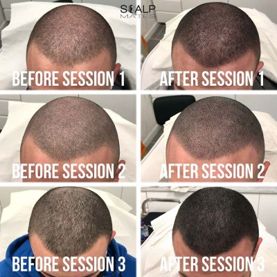 Tattoo for thinning hair front profile session progression on late 20s male
