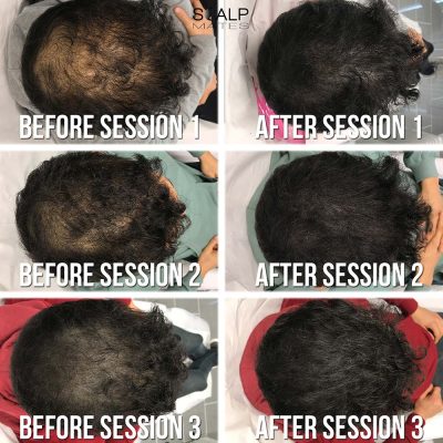 Before and after 3 session progression of tattoo for thinning hair on long hair crown and top scalp