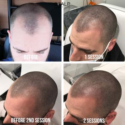 4-panel before and after progression of hair tattoo for receded hairline on a man in his 30s showing 2-session V-shape hairline restoration at ScalpMates Birmingham