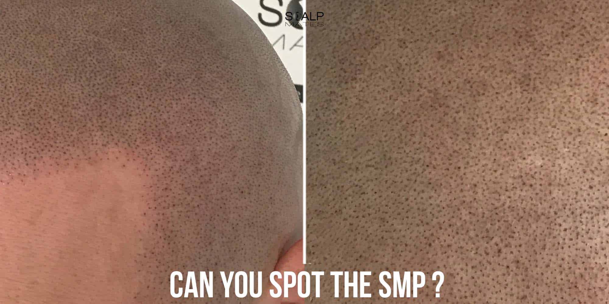 Close up micro detail of shaved look scalp micropigmentation impressions matching natural hair stubble
