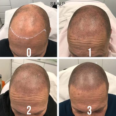 Front hairline progression from drawn hairline session 0 to finished session 3 SMP result
