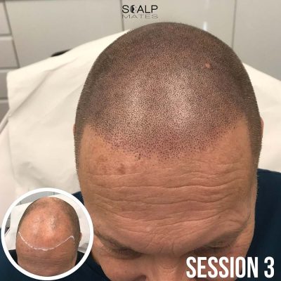 Before and after soft natural hairline scalp micropigmentation result after session 3 in Birmingham