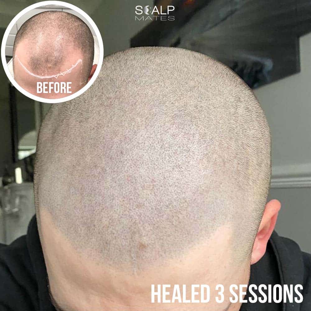 scalp micropigmentation result after 3 sessions showing natural hair follicle replication a receded hairline and on balding crown