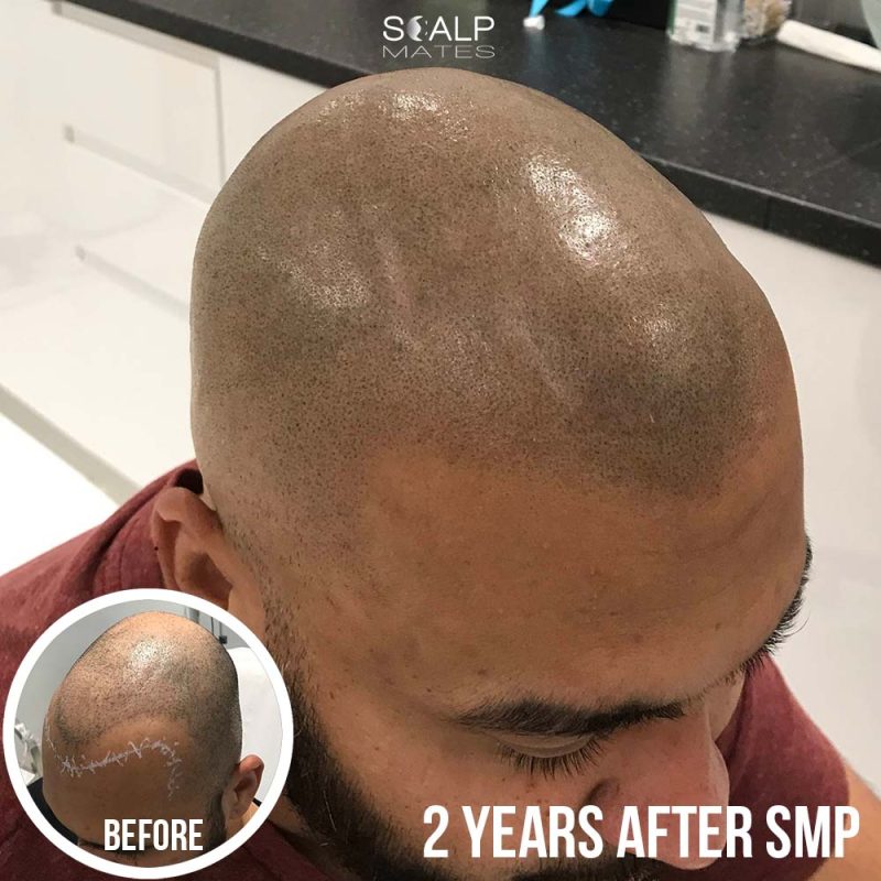 Image shows how great hair tattoo looks like after 2 years healed when doen by the best bald head hair tattoo artist Laurentiu Bradea (Laur) in bimringham uk