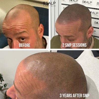 3 panel image showing before 2 sessions and healed result 3 years after scalp micropigmentation at Scalp Mates Birmingham