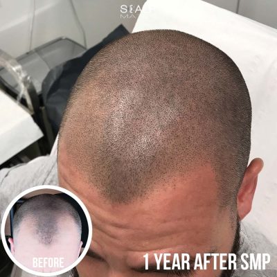 Close up view of healed scalp micropigmentation 1 year later showing natural hairline retention and organic Nocturnal Ink dots at ScalpMates Birmingham