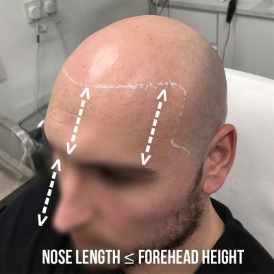 Facial symmetry mapping guide showing nose length versus forehead height for scalp micropigmentation hairline placement at Scalp Mates Birmingham