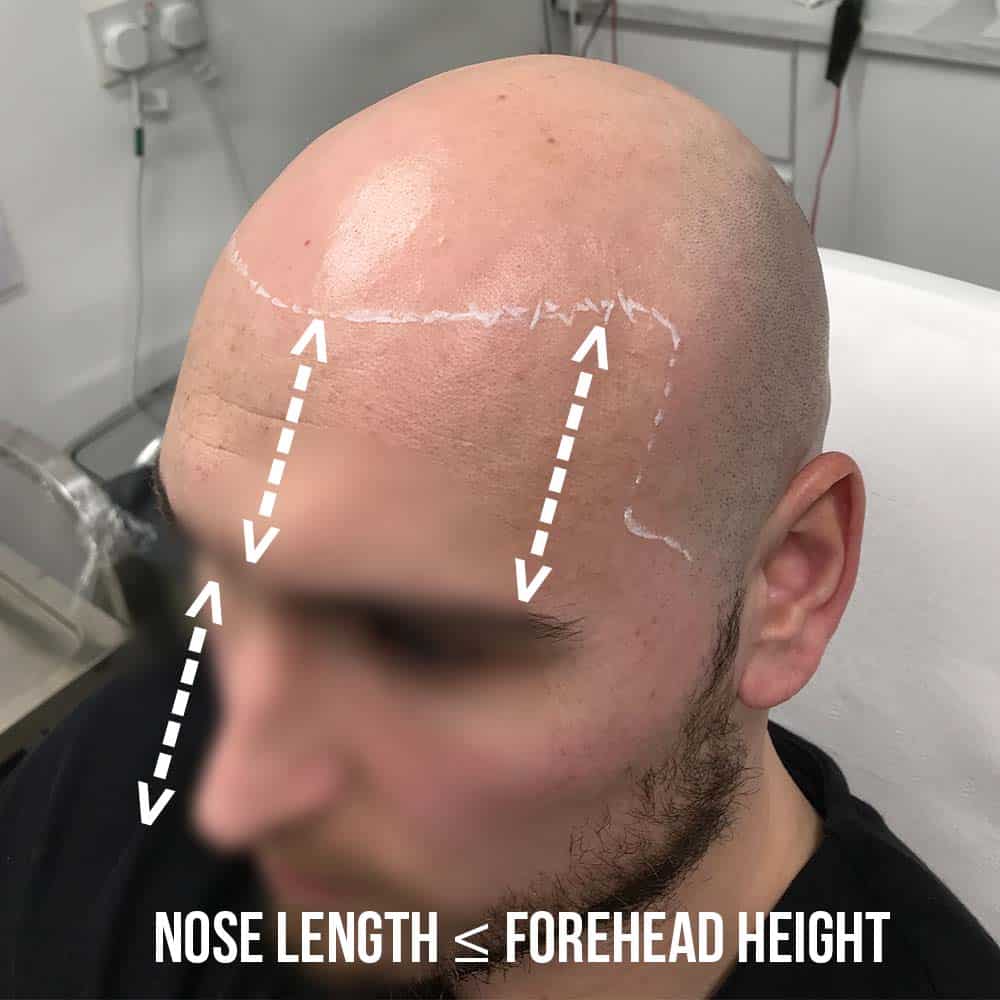 Facial symmetry mapping guide showing nose length versus forehead height for scalp micropigmentation hairline placement at Scalp Mates Birmingham