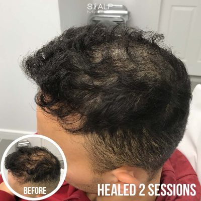 Scalp micropigmentation tattoo for thinning hair on long dark hair client side profile
