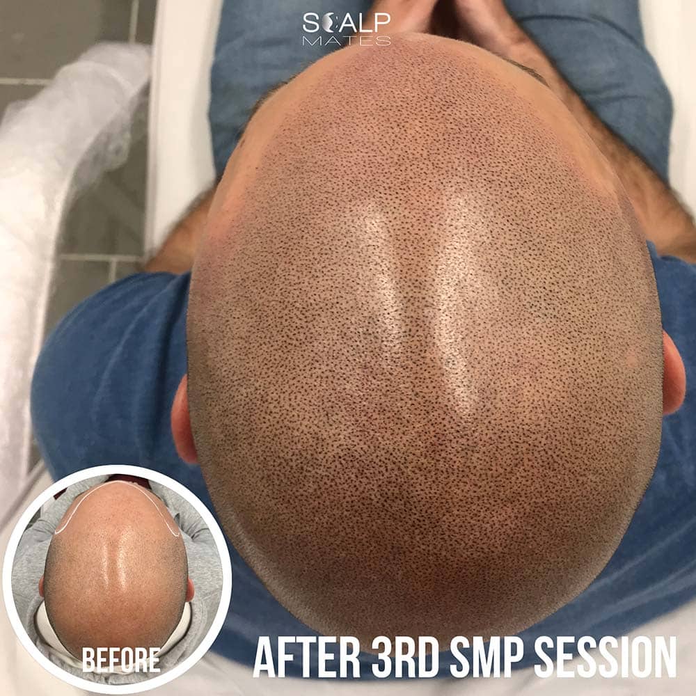 norwood 7 bald man, balding solution treatment birmingham uk, top view SMP for fair skin male