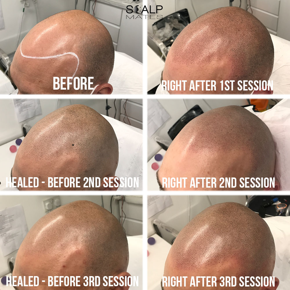 norwood 7 soft natural hairline restoration scalp micropigmentation hair tattoo at scalpmates birmingam uk, full 3 session process cost