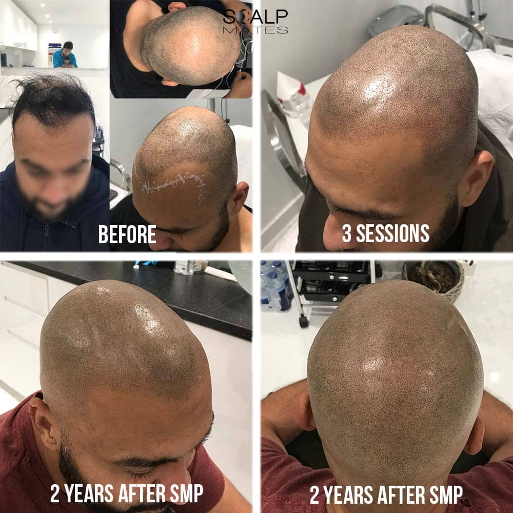 4 panel transformation of Asian male switching from a failed hair transplant to a shaved look scalp micropigmentation 2 years healed at Scalp Mates Birmingham