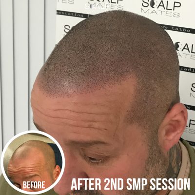 Close up profile angle after 2nd SMP session showing natural hairline definition before final healing